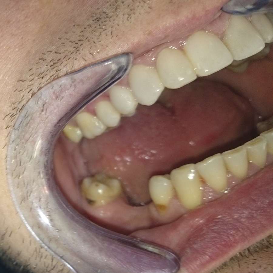 До лечения. Отсутствие зуба на нижней челюсти.