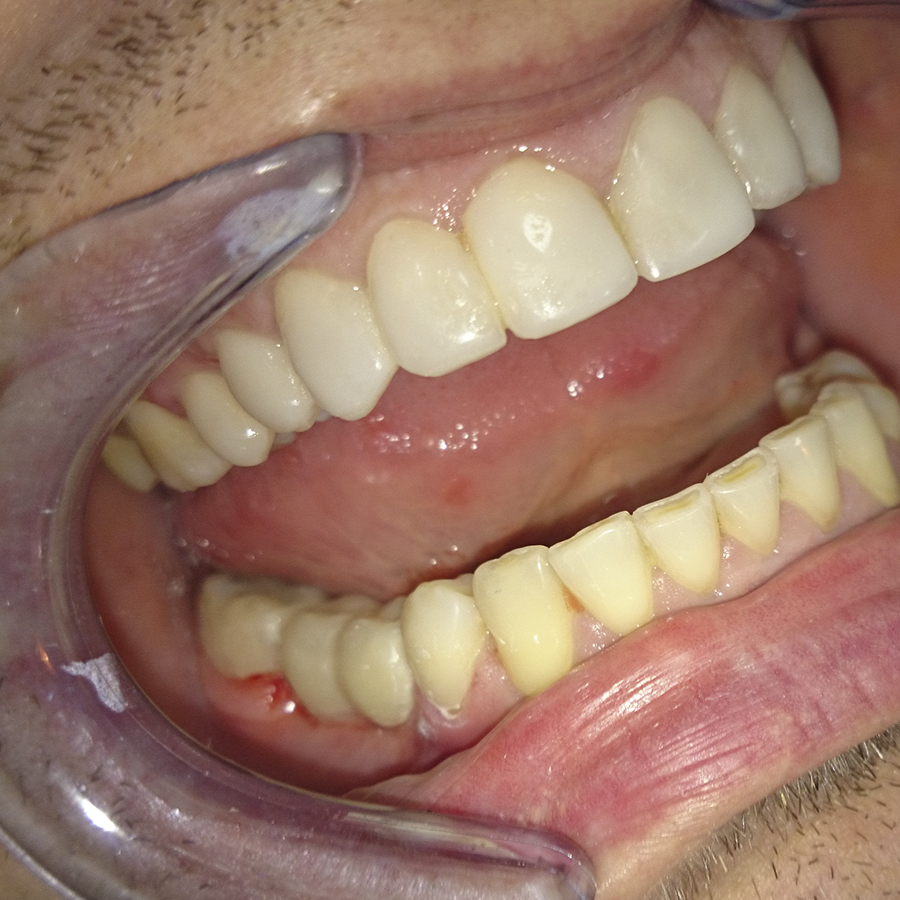 После лечения. Восстановлено отсутствие зуба на нижней челюсти.