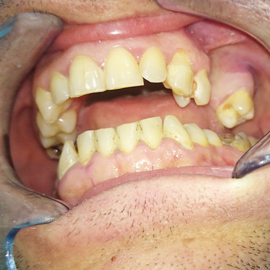 До лечения. Отсутствует 2 жевательных зуба с верху слева.