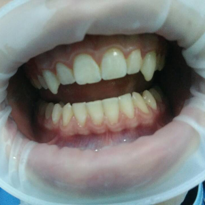 После лечения. Форма и размер клыков изменены, виниры можно убрать без травмы для зубов.
