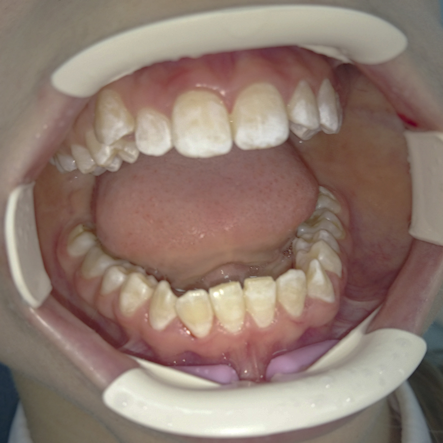 До лечения. Все зубы имеют меловидный мраморный цвет.