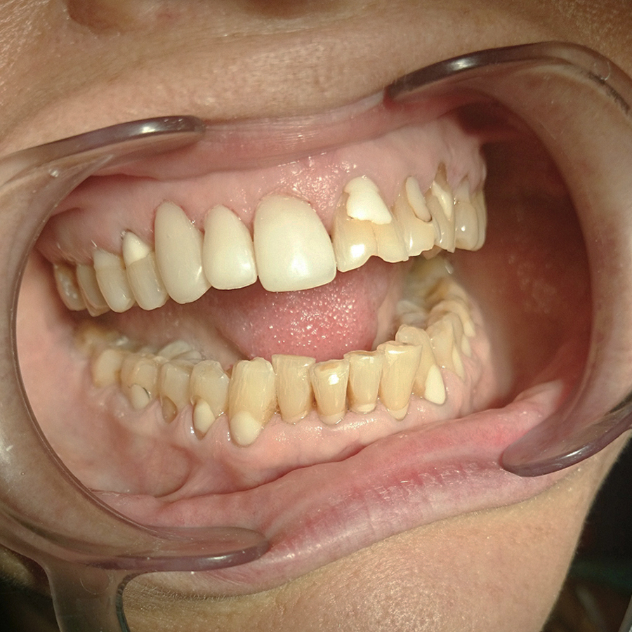 До лечения. 3 верхних зуба уже восстановлены винирами.