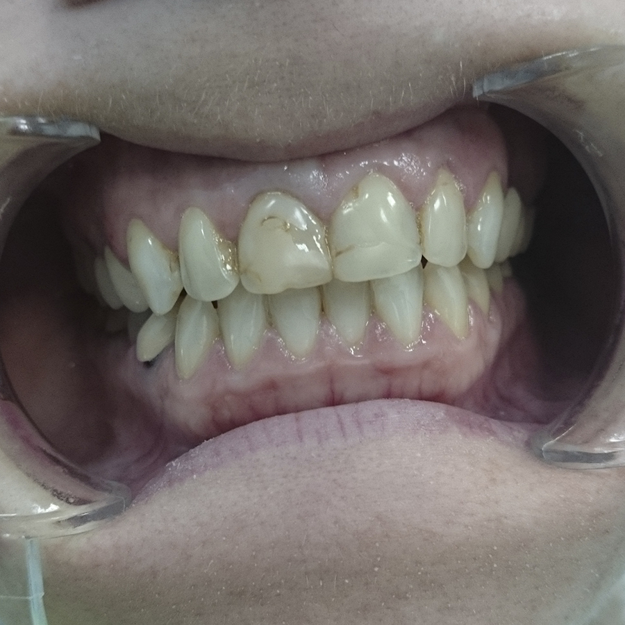 До лечения. Зубы восстановлены дефектными пломбами.