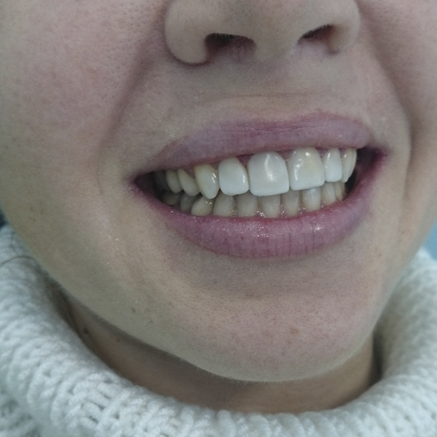 После лечения. Верхние зубы восстановлены композитными винирами.