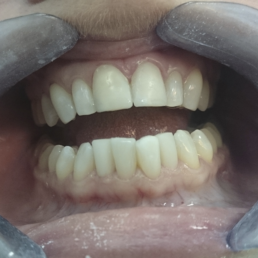 Результат лечения. Резцы находятся вровень с остальными зубами, линия смыкания резцов более ровная.