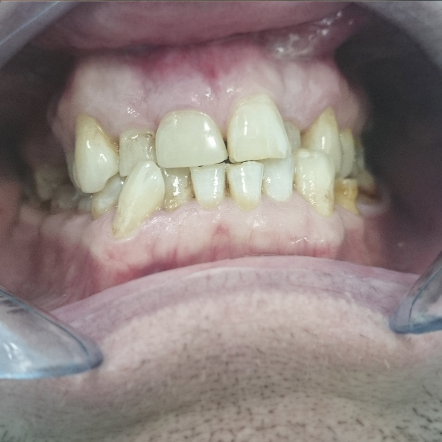 До лечения. Вторые резцы верхней челюсти блокируются зубами нижней челюсти.