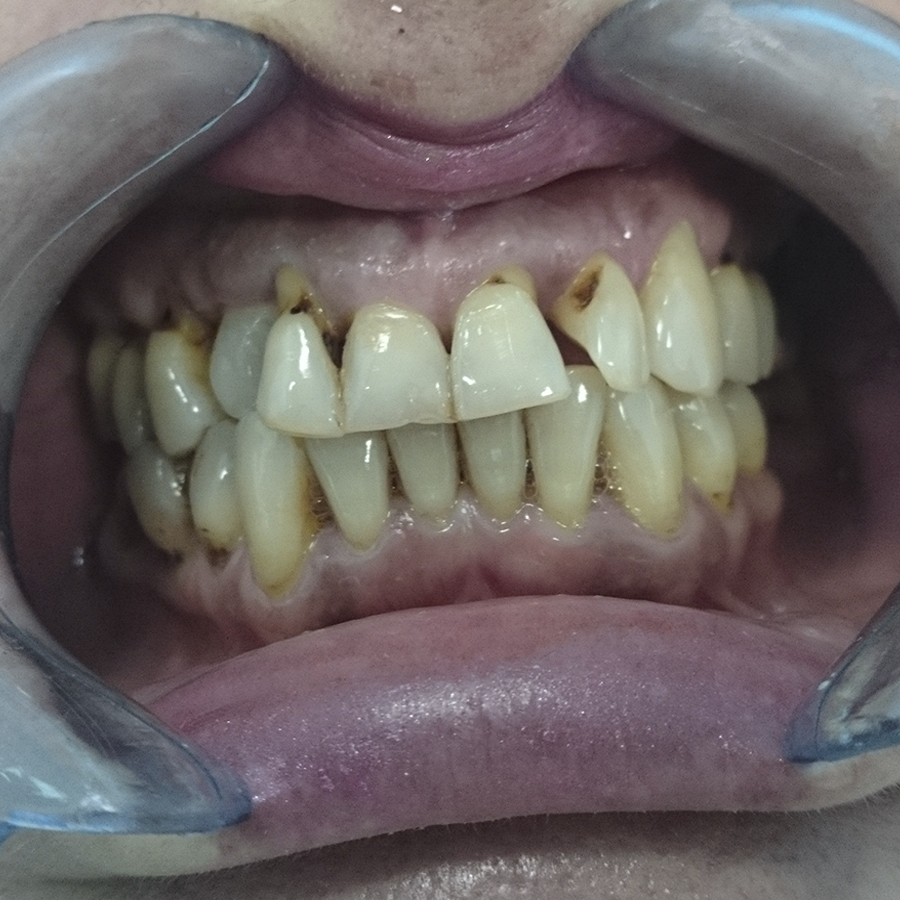 До лечения. Поворот второго резца слева, промежутки между зубами.